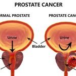 Injeksi Flotufolastat 18 Bisa Deteksi dan Lokalisasi Kanker Prostat dengan Teknologi Radiohybrid