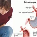 FDA Mulai Menarik Obat OTC Asam Lambung Ranitidin