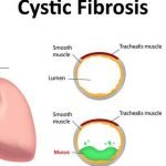 Trikafta, Terapi Kombinasi 3 Obat Pertama Untuk Fibrosis Kistik