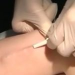 Implant Biodegradable, Strategi Efektif Tingkatkan Efektivitas dan Keamanan Pengobatan di Bidang Ortopedi