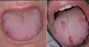 (Nuno-Gonzalez et al., British Journal of Dermatology, 2020)