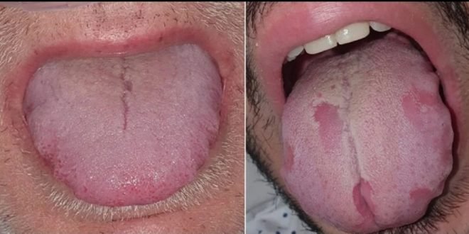 (Nuno-Gonzalez et al., British Journal of Dermatology, 2020)