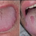 Gejala 'Sariawan COVID di Lidah' Bisa Jadi Tanda Infeksi Virus Corona