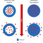 Mengenal Sediaan Implan Kontrasepsi Berbasis Polimer