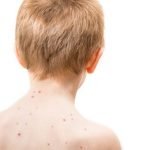 Brincidofovir, Obat Baru untuk Terapi dan Tangkal Senjata Biologis Cacar