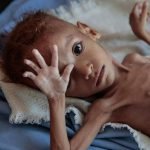 Malnutrisi Sejak Dini Pengaruhi Tingkat Kecerdasan Anak