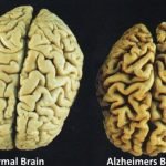 Lecanemab, Harapan Baru bagi Pasien Pengidap Alzheimer