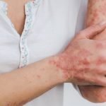Risankizumab Signifikan Mengurangi Keparahan Psoriasis Dibandingkan Apremilast