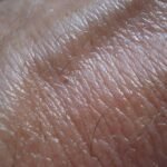 Studi Temukan Penggunaan Methotrexate Dapat Tingkatkan Risiko Kanker Kulit